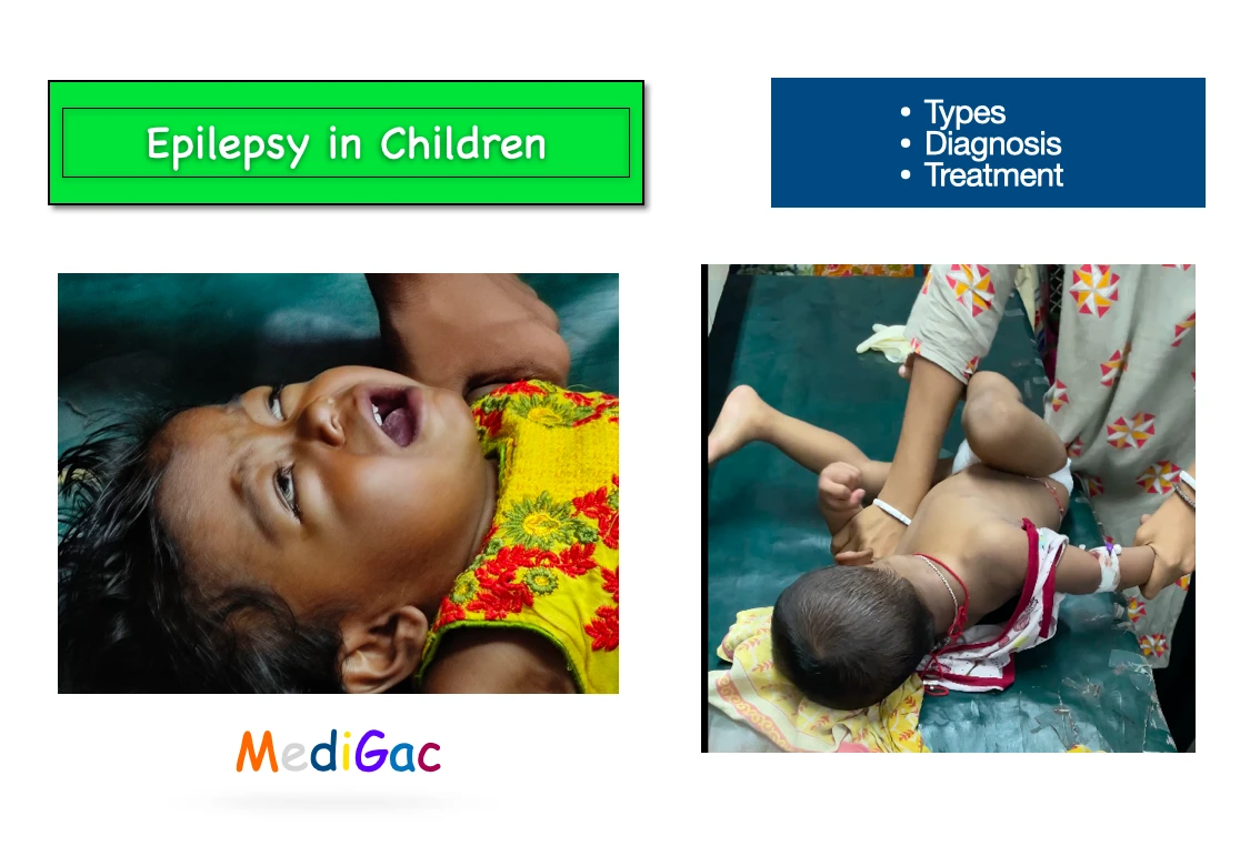 Epilepsy in children